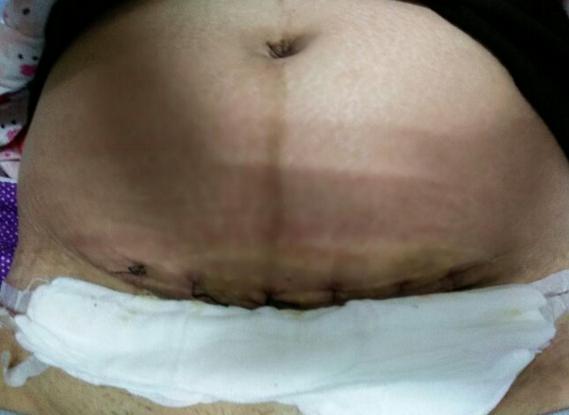 剖腹产的痛只有剖腹产的人才知道,你以为的剖腹产实际的剖腹产