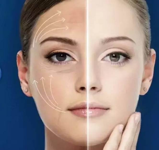 线雕对抗面部衰老的秘密,线雕抗衰依靠三方面的力量