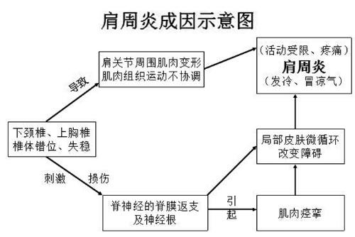 左肩周炎会引起哪些症状,肩周炎颈椎病有哪些症状