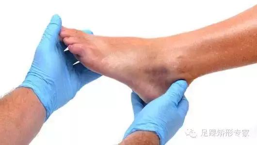 脚踝轻微扭伤不影响走路怎么消肿,足踝扭伤韧带撕裂的恢复过程