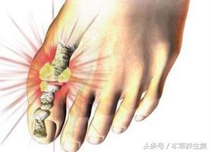 3味中药茶饮，轻松解决尿酸高问题，可预防痛风发作！