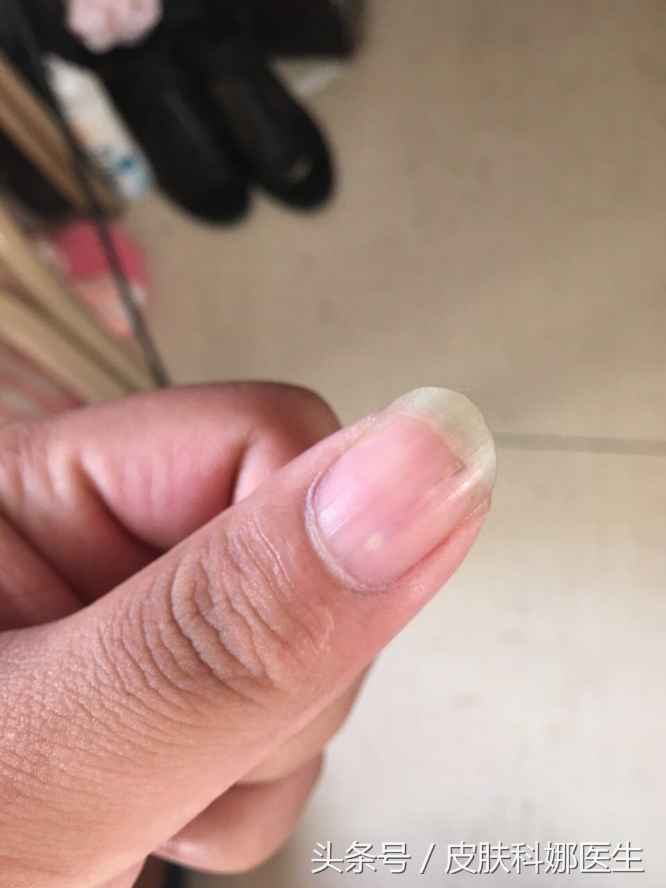 指甲里像扎了竹签一样痛什么原因,指甲壳里扎刺又肿又痛