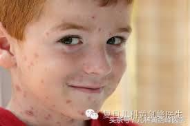 得了水痘莫惊慌,水痘高峰期如何通知家长预防