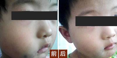 治疗胎记的方法有哪些呢,治疗胎记最先进的手段