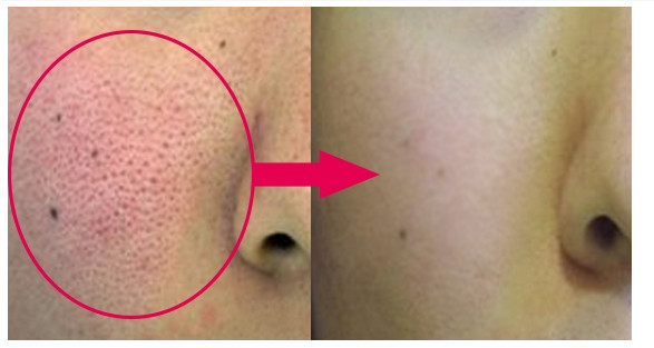 这些几毛钱的东西，用几次毛空竟然变细了！