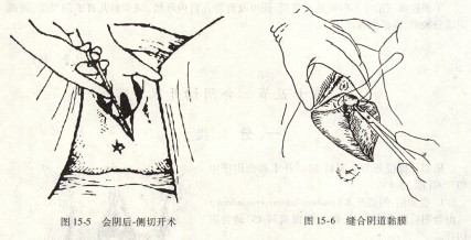 产后会阴疼,产妇生完孩子会阴痛怎么回事