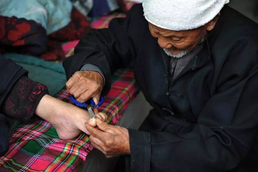 大拇脚趾盖歪长是怎么回事,锤状脚趾弯曲怎么矫正