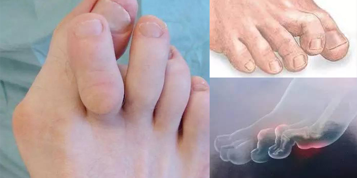 大拇脚趾盖歪长是怎么回事,锤状脚趾弯曲怎么矫正