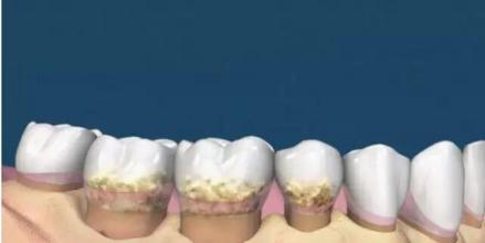 每个人都有尖尖牙吗,每个人都有牙隐纹吗