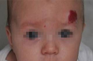 治疗胎记的方法有哪些呢,治疗胎记最先进的手段