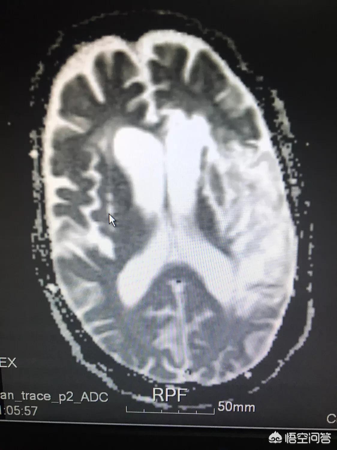 颈动脉堵塞70至80必须做手术吗,颈动脉堵塞70%以上必须放支架吗