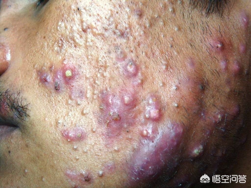 痘痘是有基因原因吗,遗传痘痘能彻底治愈吗