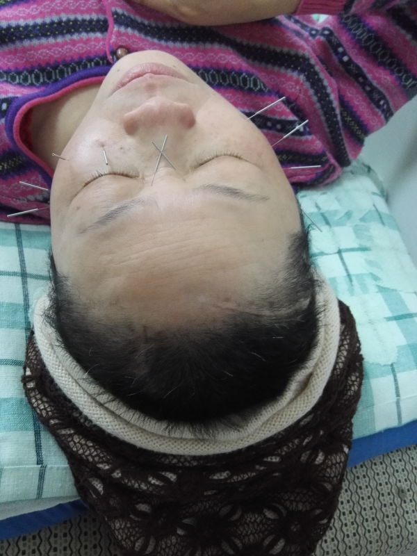 面瘫治疗最好的医院,面瘫治疗费用大概多少