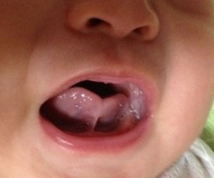 舌头下面系带处溃疡怎么治,舌头下面的系带有什么用