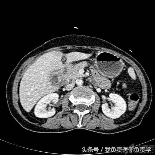 楂樻墜杩涢樁鑵拌吂璁粌,鑳嗗泭缁撶煶绌垮瓟鐥囩姸