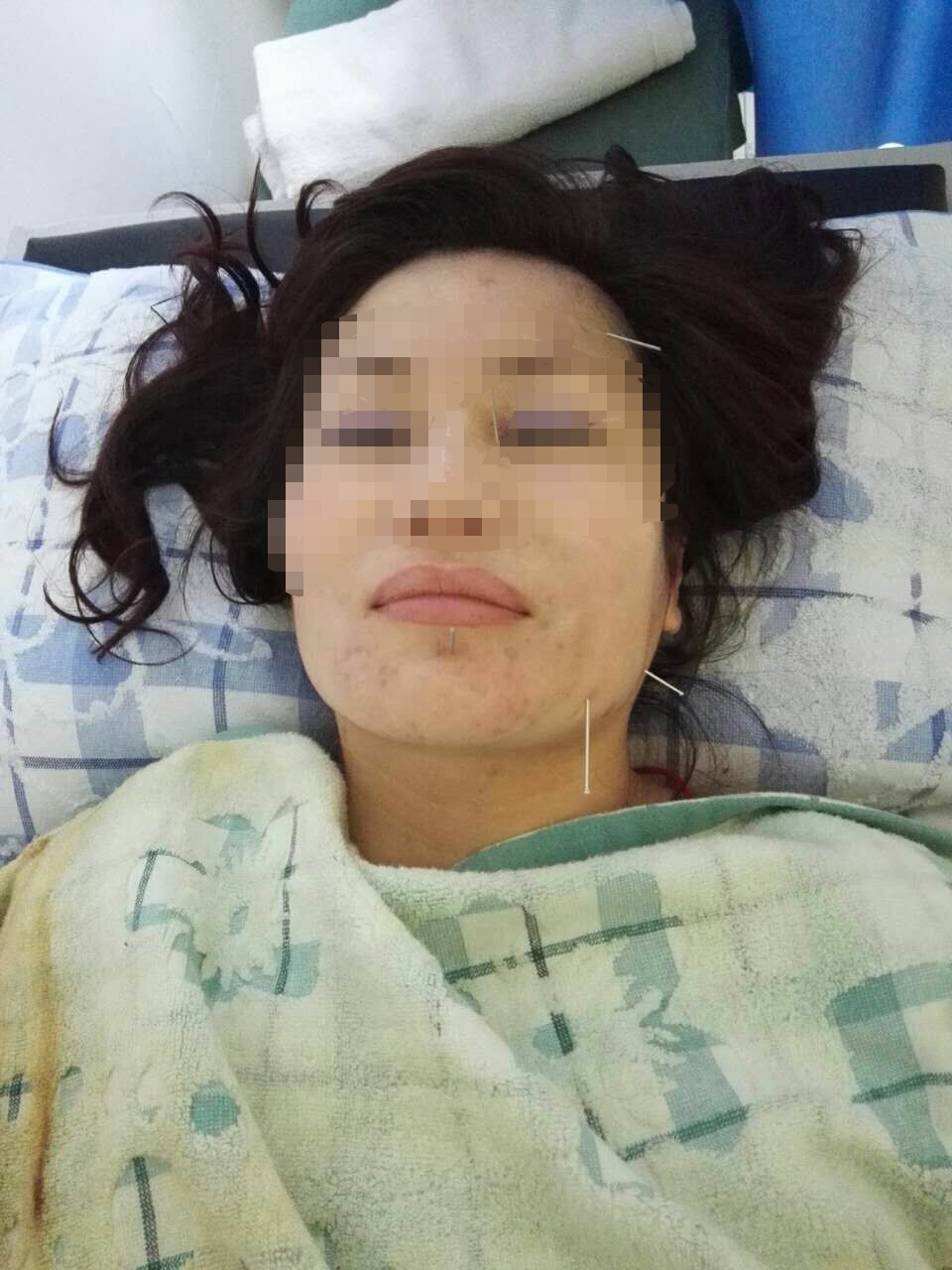 面瘫治疗最好的医院,面瘫治疗费用大概多少