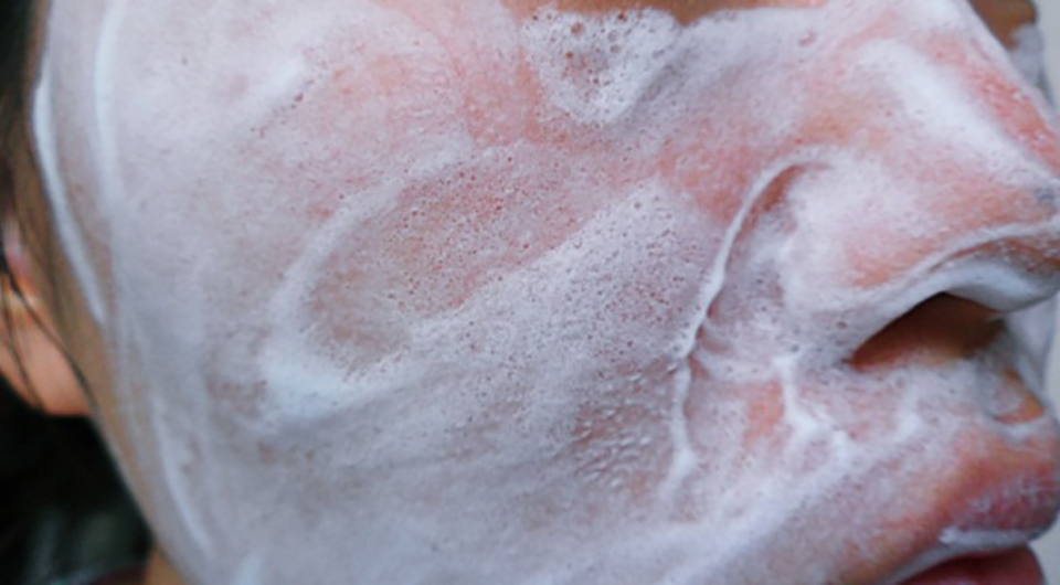 脖子闭口粉刺怎么去除小妙招,粉刺怎么去除简单方法学生