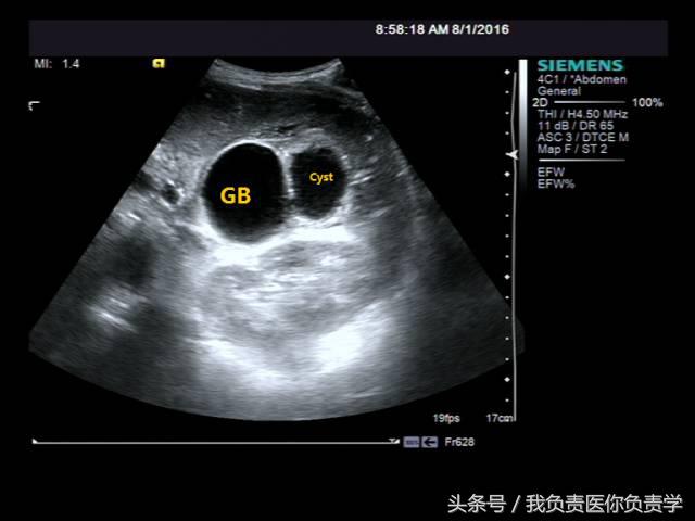 楂樻墜杩涢樁鑵拌吂璁粌,鑳嗗泭缁撶煶绌垮瓟鐥囩姸