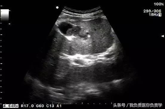 楂樻墜杩涢樁鑵拌吂璁粌,鑳嗗泭缁撶煶绌垮瓟鐥囩姸