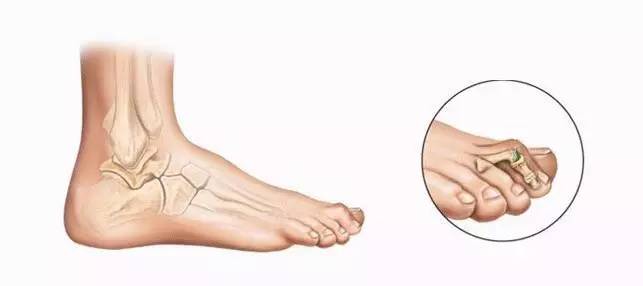 大拇脚趾盖歪长是怎么回事,锤状脚趾弯曲怎么矫正