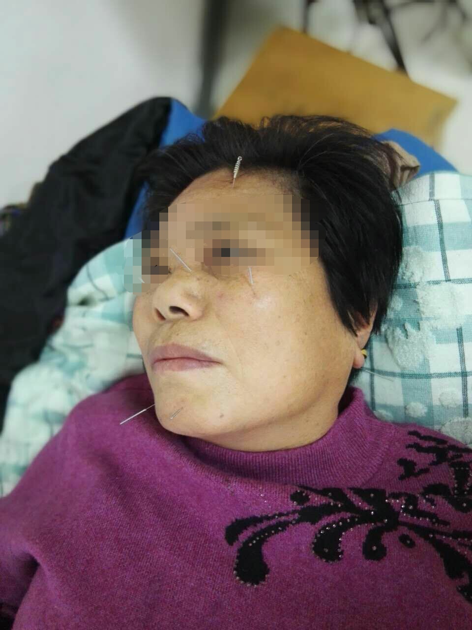 面瘫治疗最好的医院,面瘫治疗费用大概多少