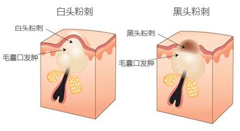 鼻子刚干净两天黑头又回来如何“彻底”去除黑头