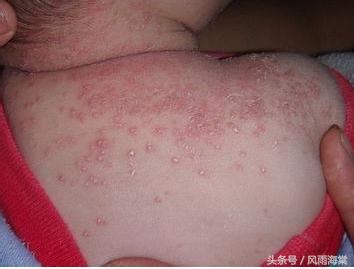 容易过敏的小孩有白癜风,湿疹引发的继发性白癜风
