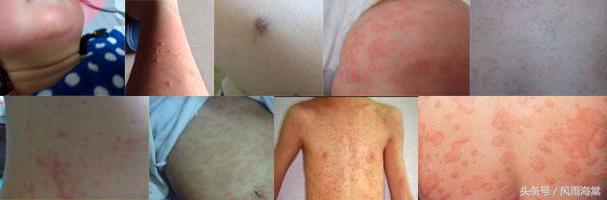 容易过敏的小孩有白癜风,湿疹引发的继发性白癜风
