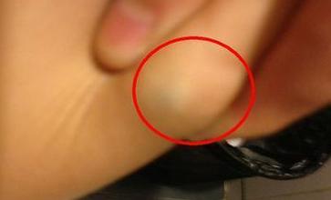 身上长脂肪瘤要不要割掉,身上长了脂肪瘤需要切除吗