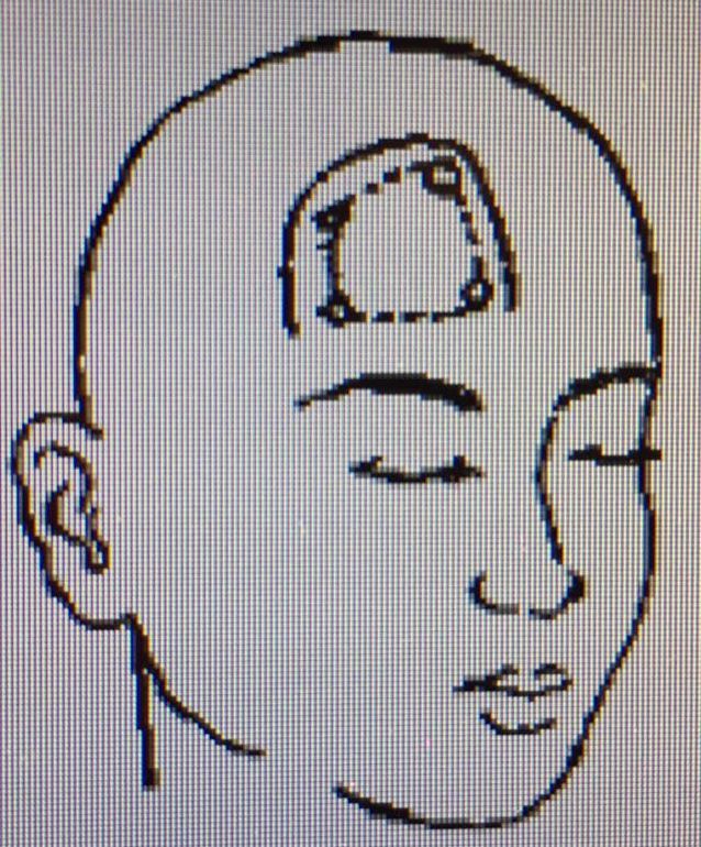 手术治疗颅咽管瘤相关问题