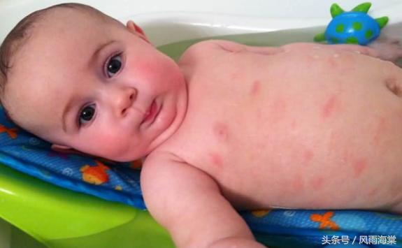 容易过敏的小孩有白癜风,湿疹引发的继发性白癜风
