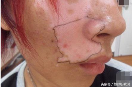 白癜风怎么才能有效控制,白癜风如何有效控制白癜风扩散