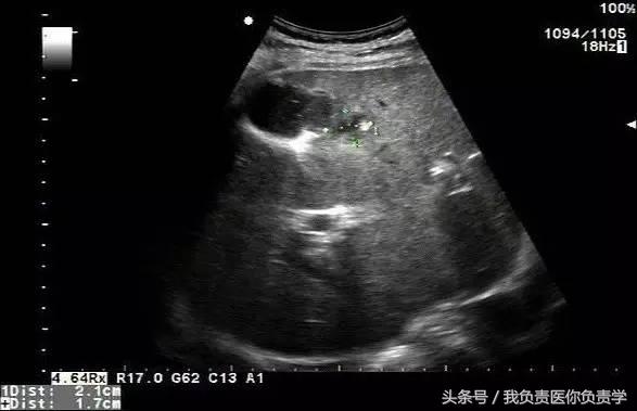 楂樻墜杩涢樁鑵拌吂璁粌,鑳嗗泭缁撶煶绌垮瓟鐥囩姸