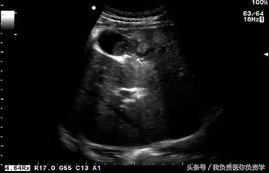 楂樻墜杩涢樁鑵拌吂璁粌,鑳嗗泭缁撶煶绌垮瓟鐥囩姸