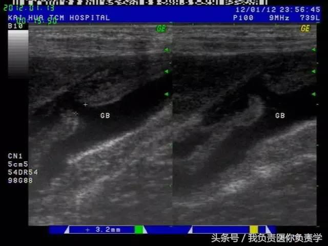 楂樻墜杩涢樁鑵拌吂璁粌,鑳嗗泭缁撶煶绌垮瓟鐥囩姸