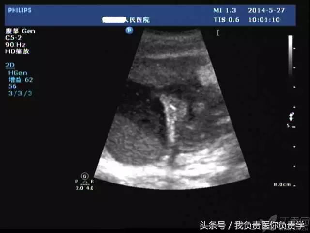 楂樻墜杩涢樁鑵拌吂璁粌,鑳嗗泭缁撶煶绌垮瓟鐥囩姸