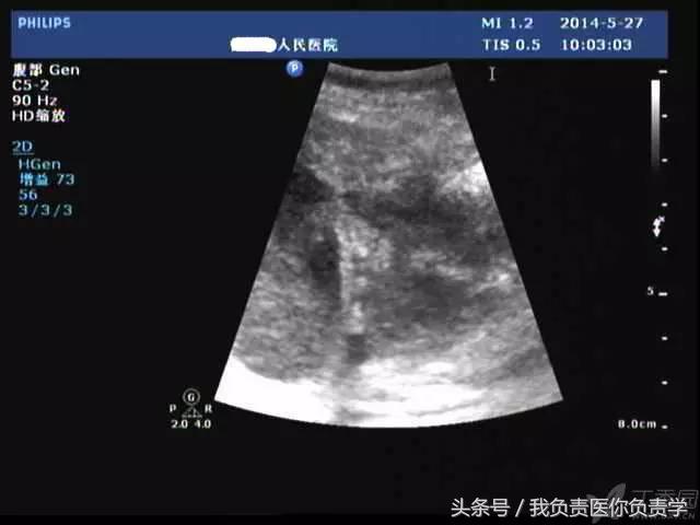 楂樻墜杩涢樁鑵拌吂璁粌,鑳嗗泭缁撶煶绌垮瓟鐥囩姸