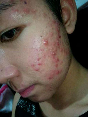 脸上的痤疮是什么原因导致的,你不在意的举动