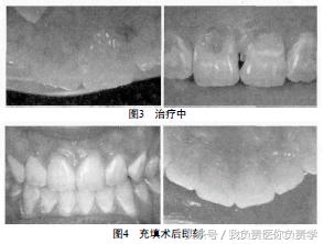 口腔疾病防治的方法,口腔龋病