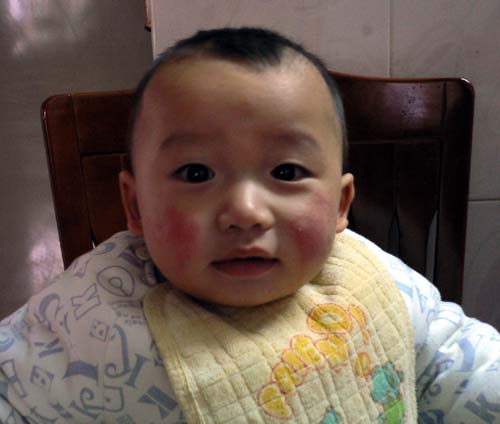 宝宝冬季冻伤,宝宝冻着了会导致低温吗