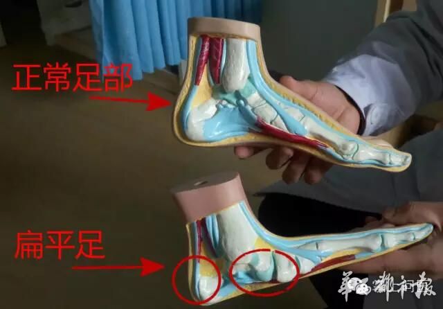鞋底磨损看出健康问题,如何通过鞋底磨损判断足弓类型