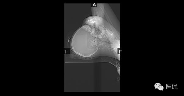 专家讲解脑白质疏松症,脑部核磁显示轻度脑白质疏松