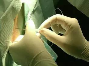 关于麻醉这些关注事项要知道,硬膜外麻醉的术后关注事项