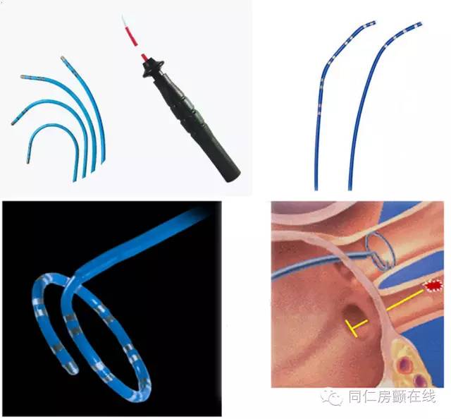 射频消融手术治房颤,房颤的射频消融术指南解读