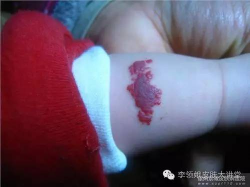 超导治疗婴幼儿血管瘤,婴幼儿面部淋巴血管瘤