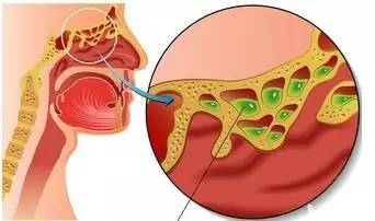 口臭腥臭味有痰什么原因,有口臭还经常咳出黄色小米粒