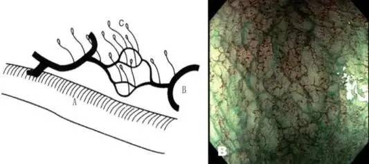 早期贲门癌内镜特征,内镜早癌