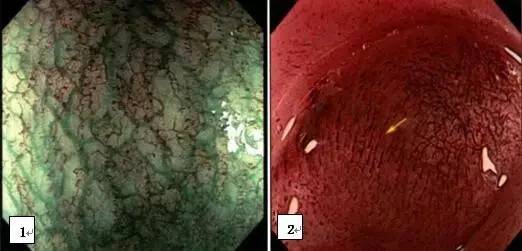 早期贲门癌内镜特征,内镜早癌