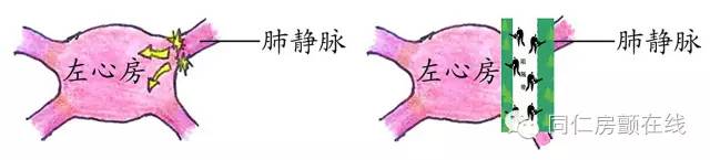 射频消融手术治房颤,房颤的射频消融术指南解读