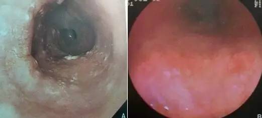 早期贲门癌内镜特征,内镜早癌